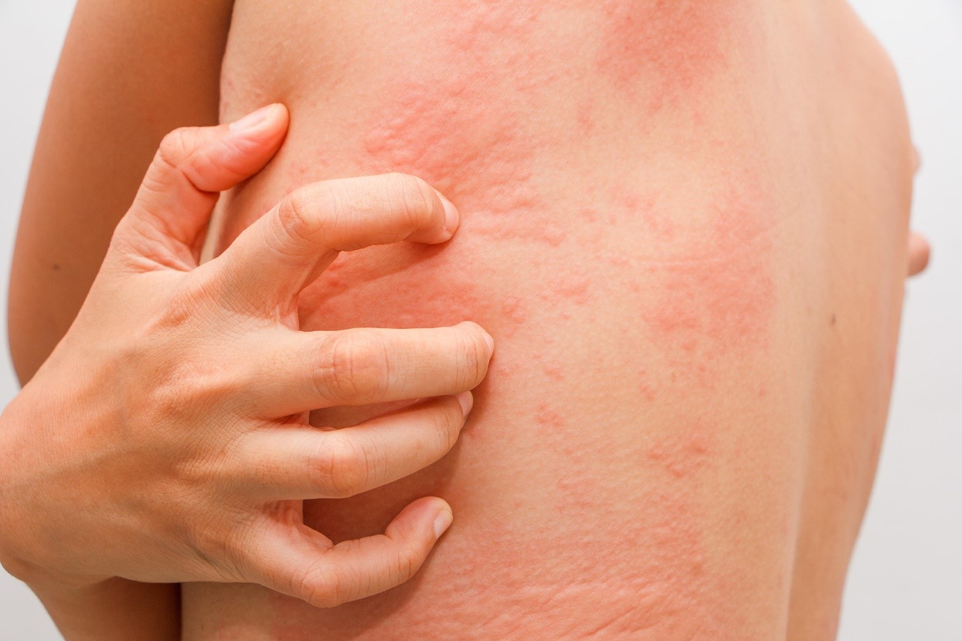 Allergy skin testing